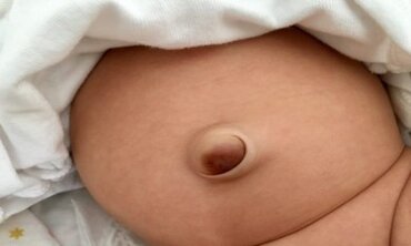 Những bất thường ở trẻ sơ sinh sau khi rụng rốn