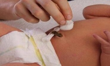 Chăm sóc rốn cho trẻ sơ sinh như thế nào?