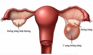 Khối u buồng trứng (còn gọi là U nang buồng trứng)