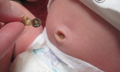 Nhiễm trùng rốn ở trẻ sơ sinh